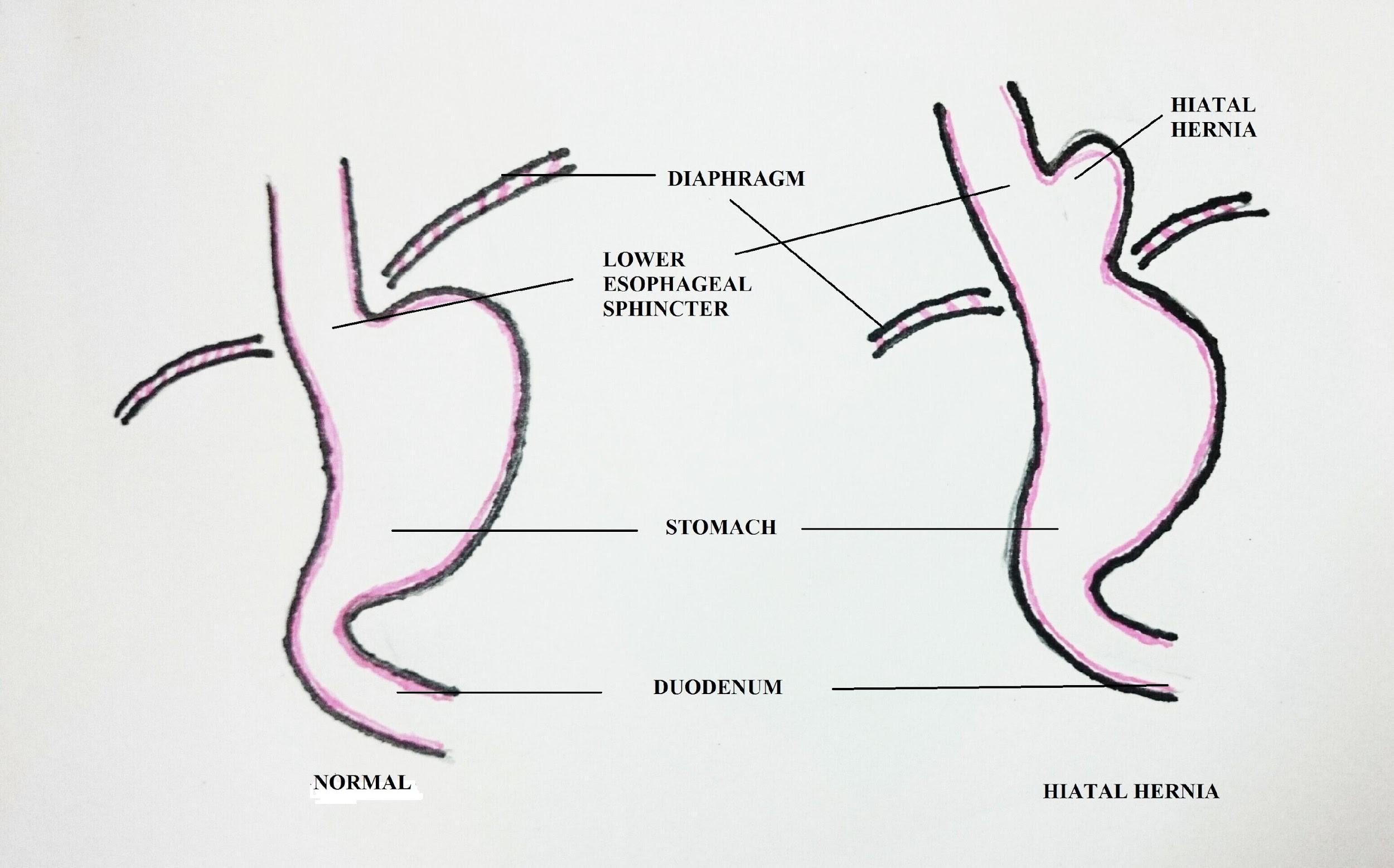 Causes of GERD Risk factors for Developing GERD PatientsEngage